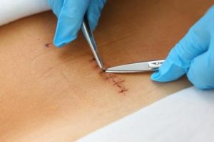 手术后拆线几个月有线头在肉里怎么办?